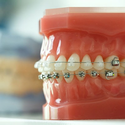 A smile model with braces, one option for bite adjustment